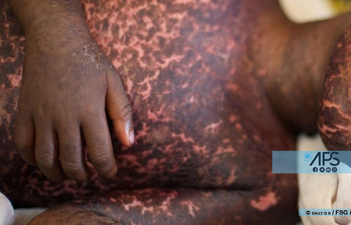 Bignona : un cas de rougeole enregistré à Badioncoto (médecin-chef)