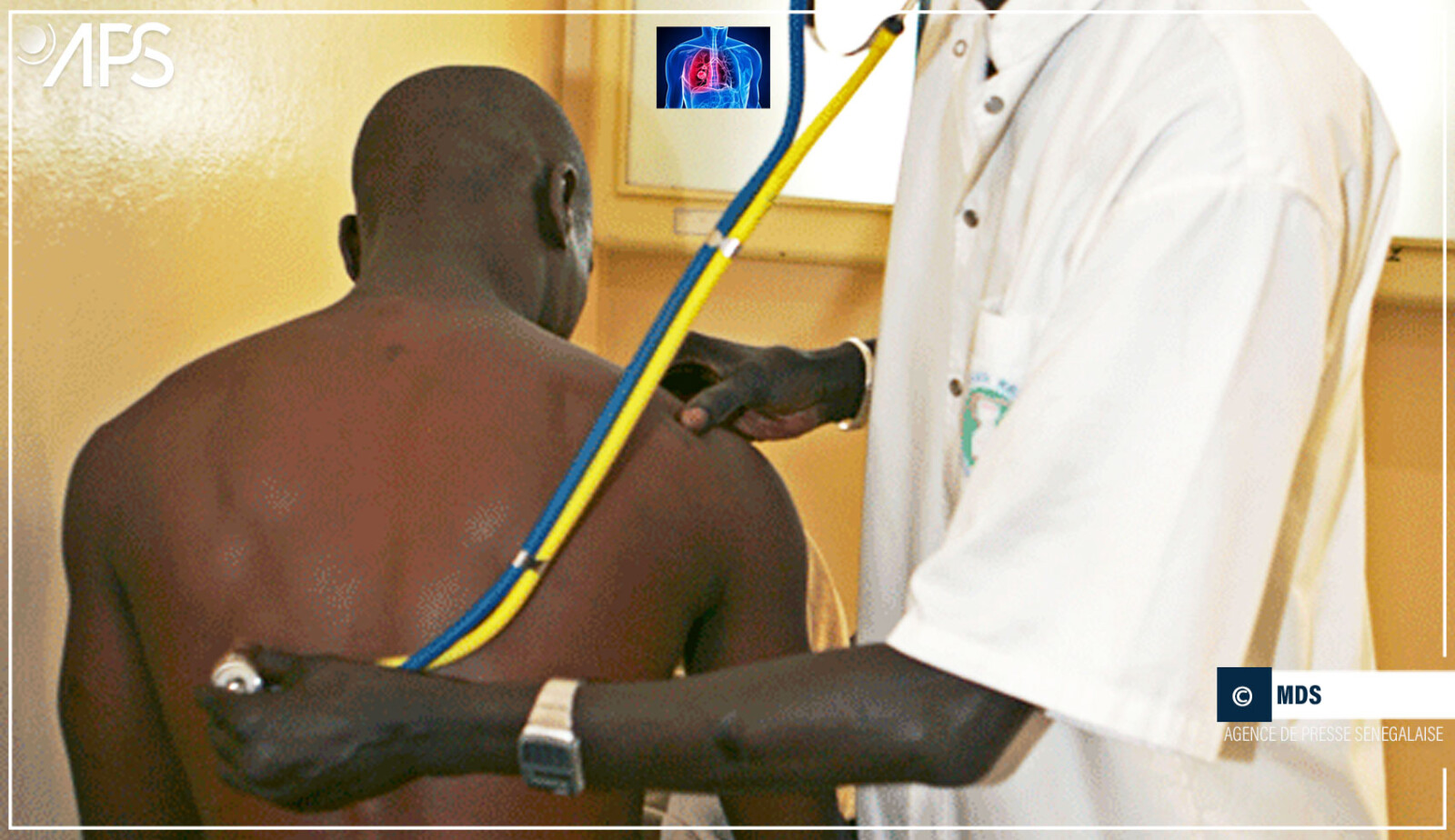 Keur Samba Kane : inquiétude autour de la recrudescence des cas de tuberculose