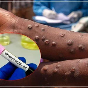 Fièvre de la Vallée du Rift : tous les foyers éteints à Saint-Louis (DRS)