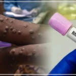 Trois décès sur 39 cas confirmés, bilan de la FVR à Fatick en 2025