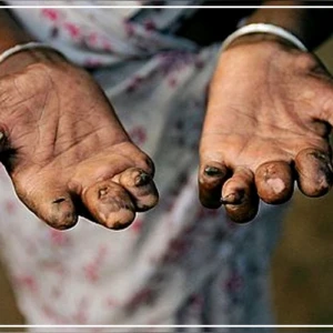 Une hausse des cas de lèpre enregistrée à Touba (responsable)