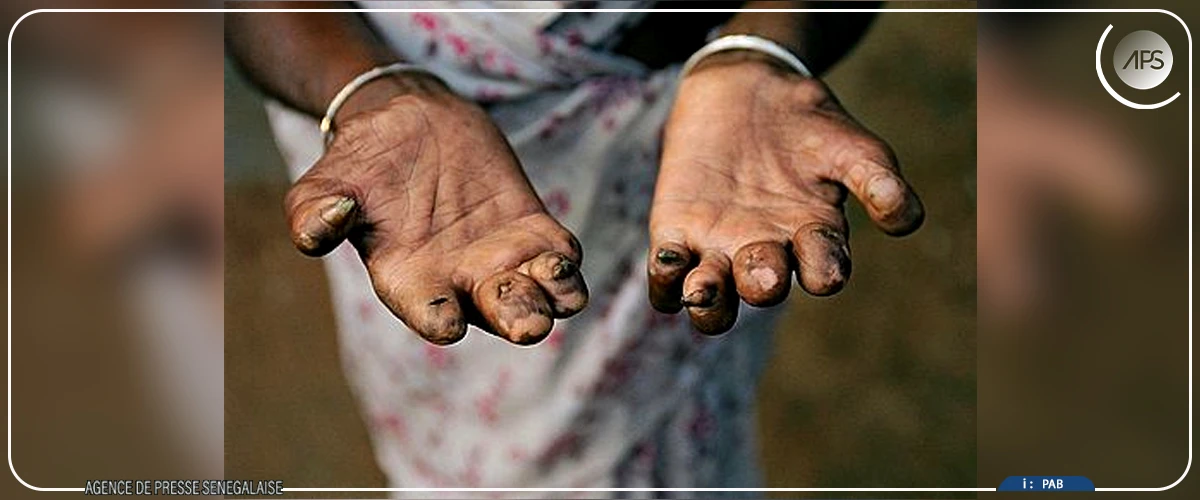 Une hausse des cas de lèpre enregistrée à Touba (responsable)
